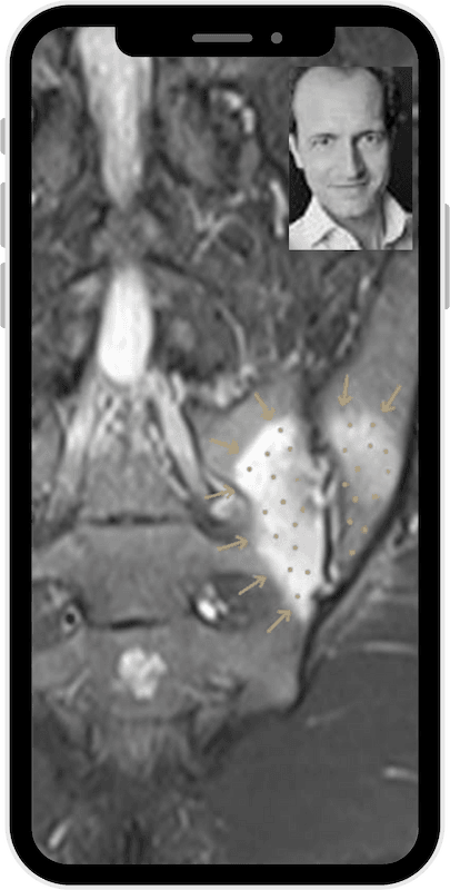 sacroiliitis-dd-isg-arthrose-mrt-----2 ISG Entzündung oder ISG Arthrose MRT