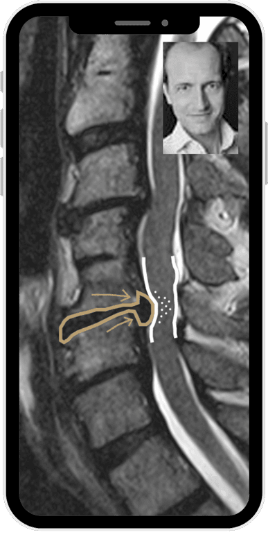 talk2friedrich-bandscheibenvorfall-hws Bandscheibenvorfall HWS Spinalkanalstenose HWS