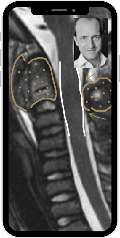 talk2friedrich-mrt-hws-tumor MRT HWS Tumor